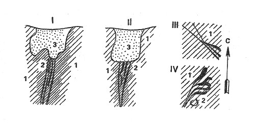 Тагильский массив. Шлировые выделения хромита с платиной (черное). 1 - дунит, 2 - измененный дунит (змеевик), 3 - разрушенные породы с платиной